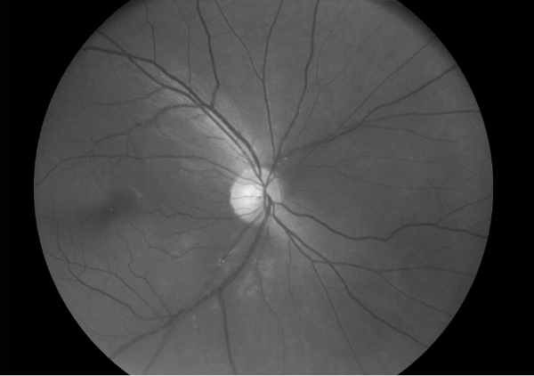 Optomed Aurora – Malaysia Ophthalmic Innovator